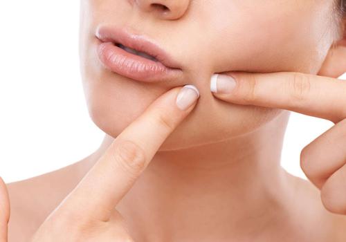 女性粉刺是怎么形成的 这几点要注意