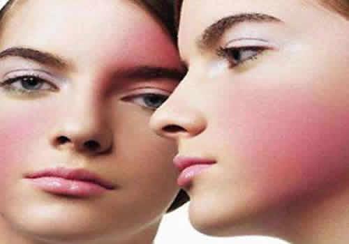 水乳过敏什么症状 怎样预防水乳过敏