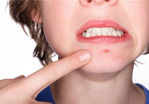 长痘痘的原因有哪些 怎么祛痘最有效