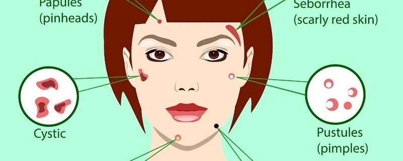 刷酸要多久时间 刷酸后需要用粉刺针吗