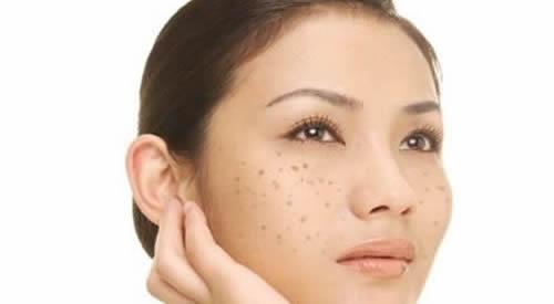 蝴蝶斑怎样去除