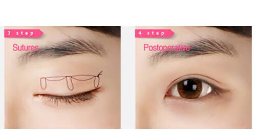 埋线双眼皮好吗