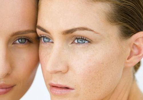 产后祛斑的最佳时期 这样做让斑点快速消失