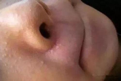 脸上脂肪粒怎么去除 小妙招去除脸上脂肪粒