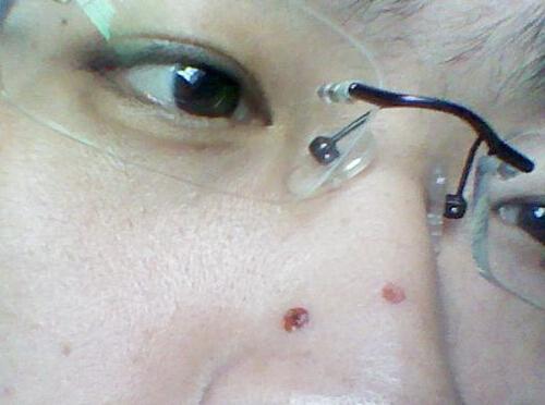 激光点痣多久能恢复