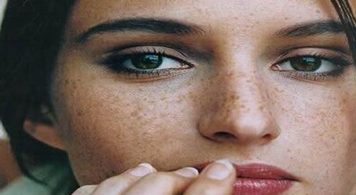 蝴蝶斑可以去除吗