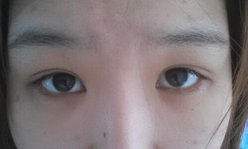 埋线双眼皮能保持几年 埋线双眼皮能保持多久