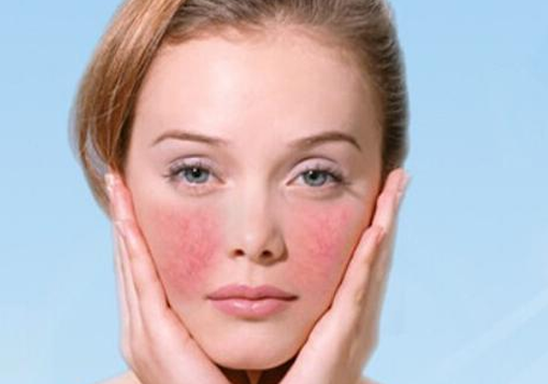 脸颊有红血丝怎么改善 淡化红血丝的6个方法