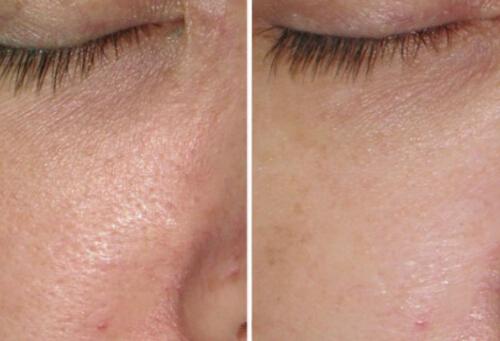 光子嫩肤对皮肤的伤害 光子嫩肤安全吗