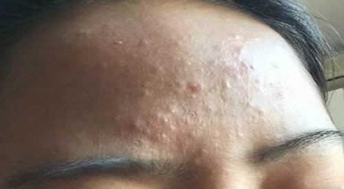 闭口粉刺为什么会痒