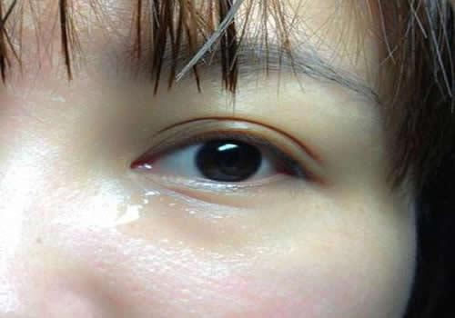 下眼袋有皱纹怎么去除 下眼袋有皱纹的注意事项