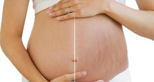 妊娠纹怎样能消除 5种方法帮你去除
