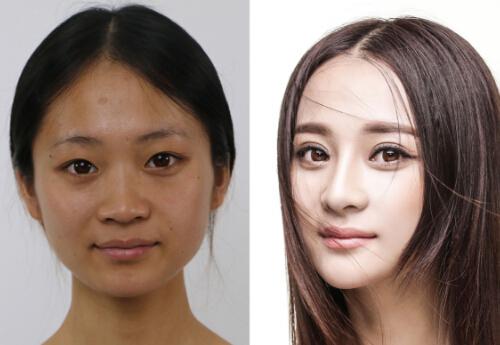 天生黑激光美白有用吗 激光美白有用吗