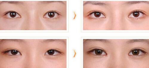 割双眼皮有什么危害性 埋线双眼皮后遗症