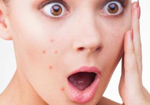 痘痘发炎红肿怎么办 5招帮你缓解