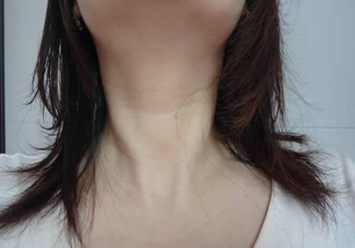 20岁有颈纹怎么办 想要去除20岁的颈纹,其实很简单!