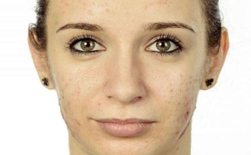 为什么脸上总是长脓包 脓包型痤疮产生的几个主要原因