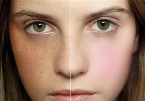 敏感肌肤可以激光祛斑吗