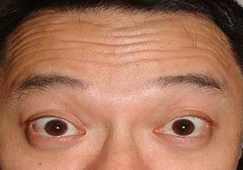 20岁有抬头纹怎么办 20岁的抬头纹需引起重视，早治疗早恢复！