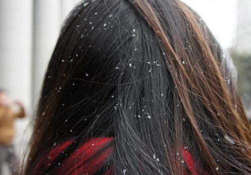 头皮屑多是什么原因 导致的头屑的7个因素