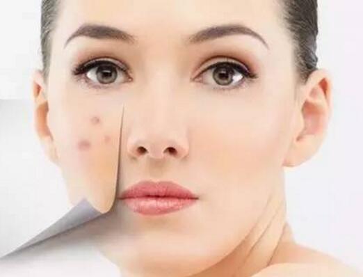 痘疤怎么消除 痘疤是怎么形成的