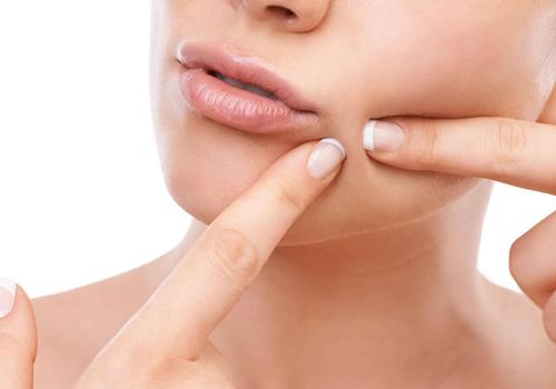 粉刺是怎么形成的 祛除粉刺的小妙招