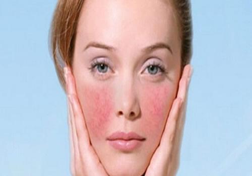 脸上有红血丝是敏感肌肤吗 红血丝敏感肌肤的保养方法