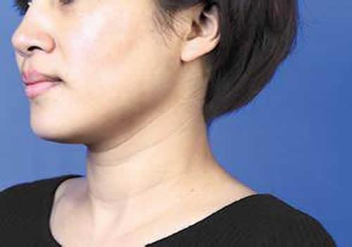 颈纹形成跟年龄有关吗 令颈纹产生的主要“杀手”竟然是它！