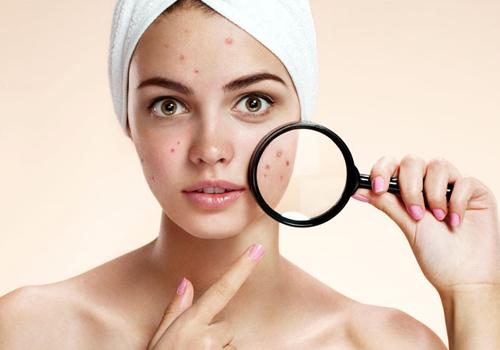 妈富隆可以祛痘吗 妈富隆祛痘效果好吗