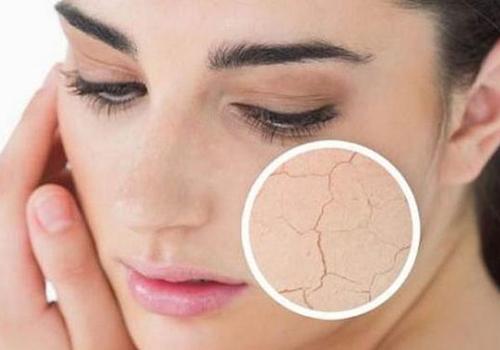 干性皮肤为什么容易长斑 干性皮肤长斑怎么办