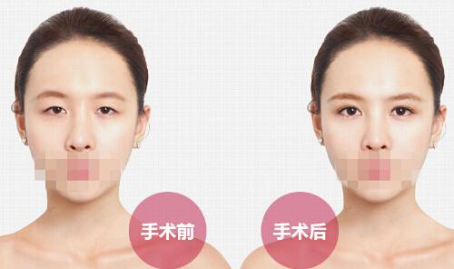 埋线双眼皮多久恢复自然