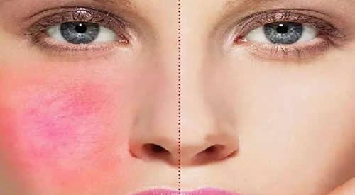 自制面膜去红血丝