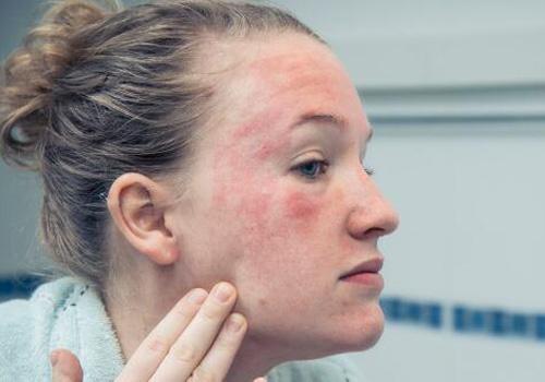 皮肤过敏发红怎么办 这6点要注意