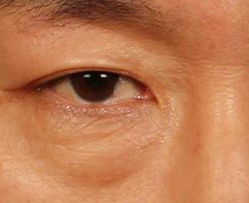 激光去眼袋多久恢复