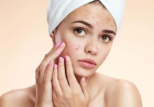 额头上长痘痘是什么原因 快看看你中了那一条