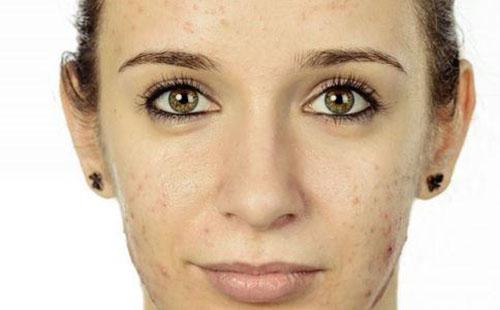 长痘痘不能吃什么 长痘痘最忌讳的饮食习惯