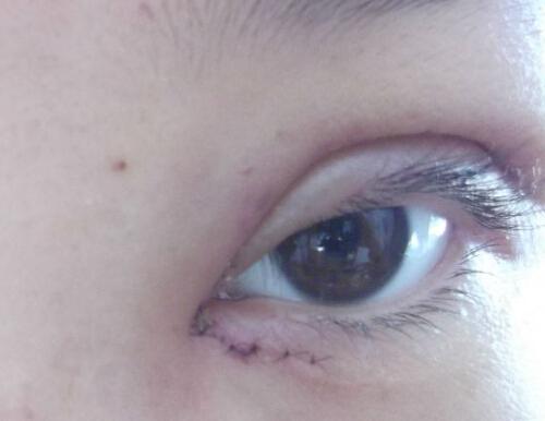 韩式三点双眼皮多久恢复好 韩式三点双眼皮恢复期