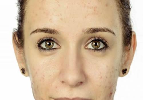 吃辣椒长痘痘怎么消除 吃辣椒长痘痘不用怕，这样祛痘再辣也敢吃！