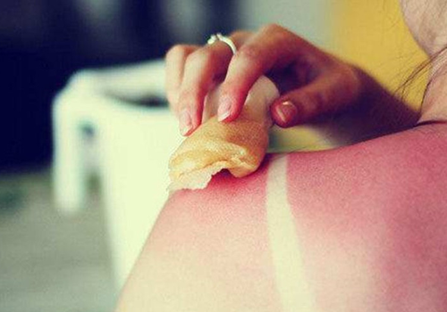 皮肤晒伤后发红怎么办 5个晒后修复小妙招