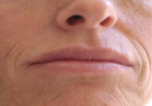 嘴角纹很深怎么办 再深的嘴角纹也能这么去除