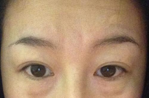 激光去眼袋效果如何