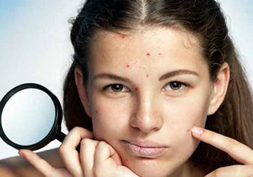 怎么用粉刺针去闭合粉刺