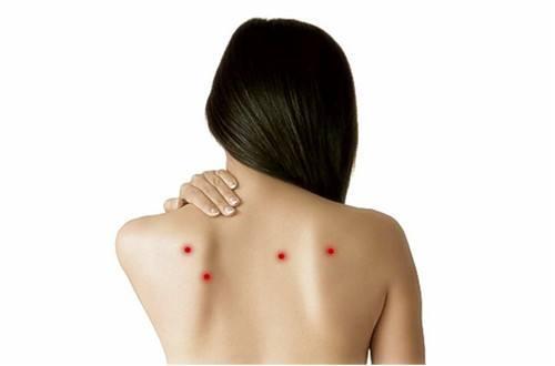 冬天后背长痘痘是什么原因 祛痘记得这样做