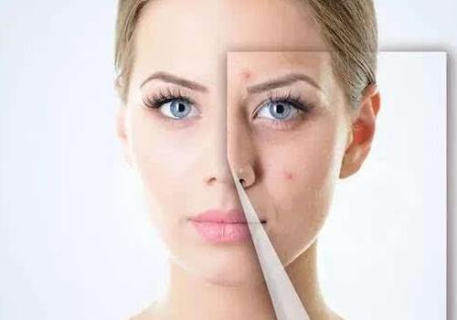 去痘印最有效的方法 教你如何快速去除痘坑