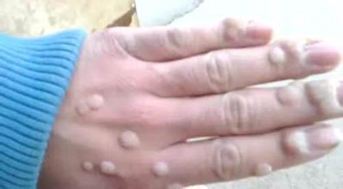 鱼痣是怎么形成的 鱼痣怎么去除小妙招