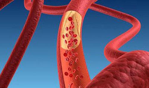 胆固醇高有什么症状 胆固醇高有什么症状和危害