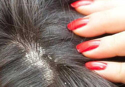 冬季头皮屑多是什么原因（秋冬季头皮屑多是什么原因）