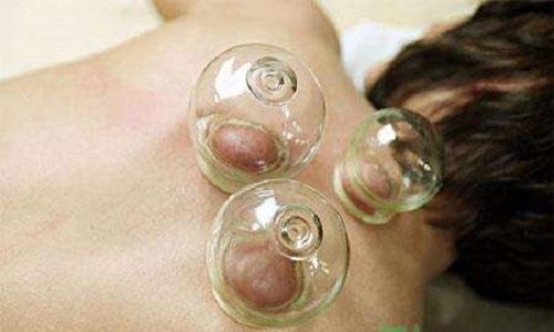 头痛拔罐拔哪里 头痛拔罐拔哪里 图解