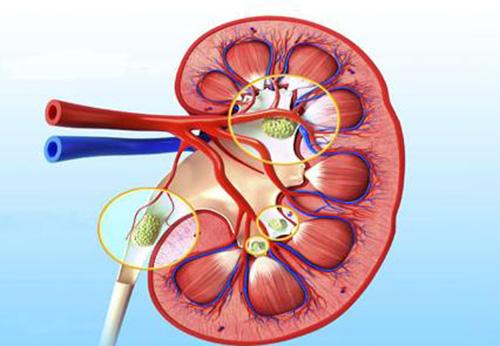 肾结石是什么引起的（男的肾结石是什么引起的）
