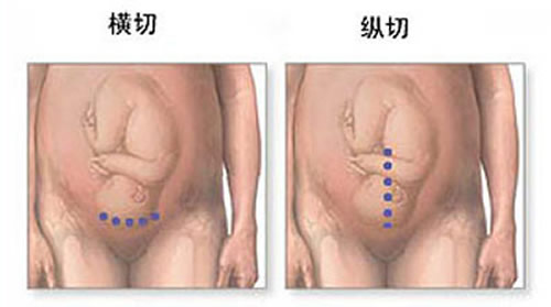 剖腹产横切还是竖切好 剖腹产手术横切好还是竖切好